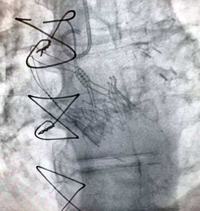 Imagen de la v&aacute;lvula implantada